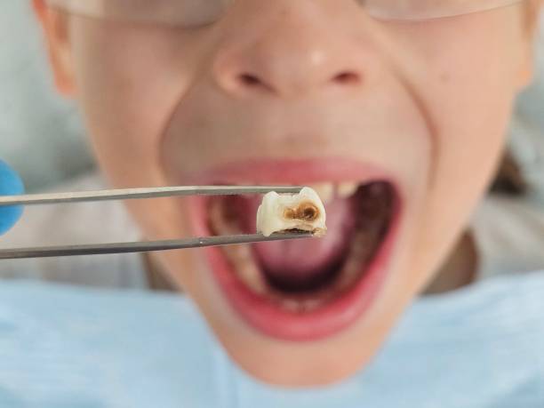 Best Emergency Dentist for Lost Fillings or Crowns in Lordstown, OH
